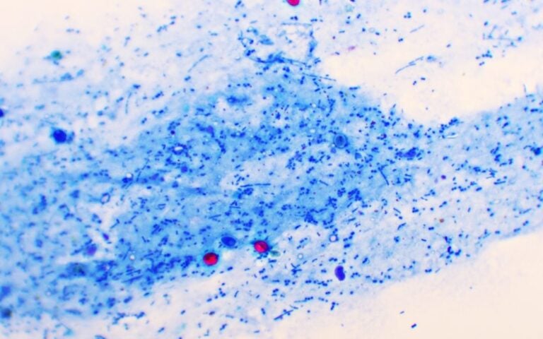 Cryptosporidium Infection Claims - Wollens Solicitors Devon